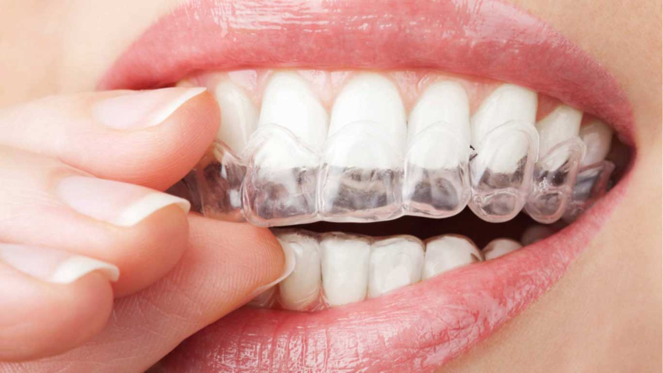 تقويم الأسنان الشفاف - عيادة أسنان أوبتمم كير - د. هبة عمار - استشاري تجميل الاسنان و التركيبات