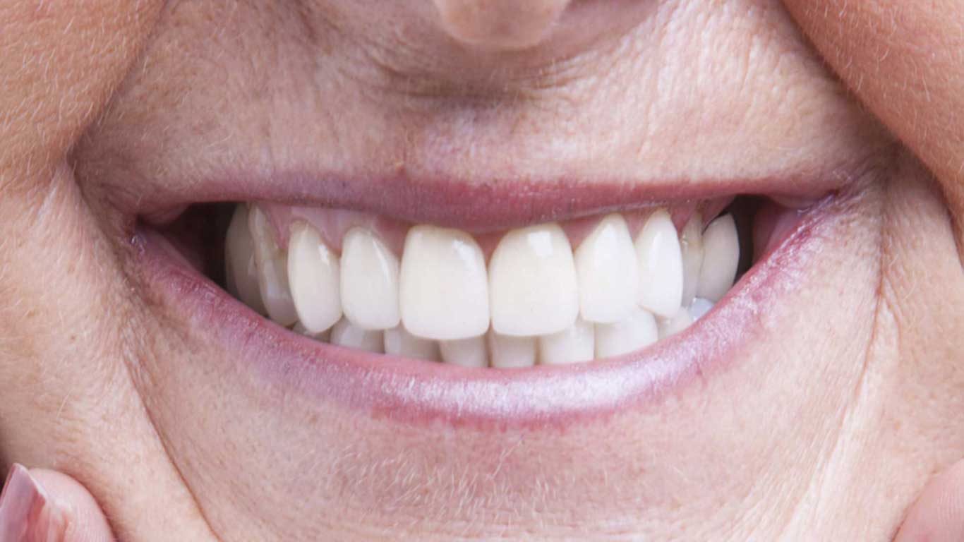 زراعة الأسنان الكل على ٤ - عيادة أسنان أوبتمم كير - د. هبة عمار - استشاري تجميل الاسنان و التركيبات
